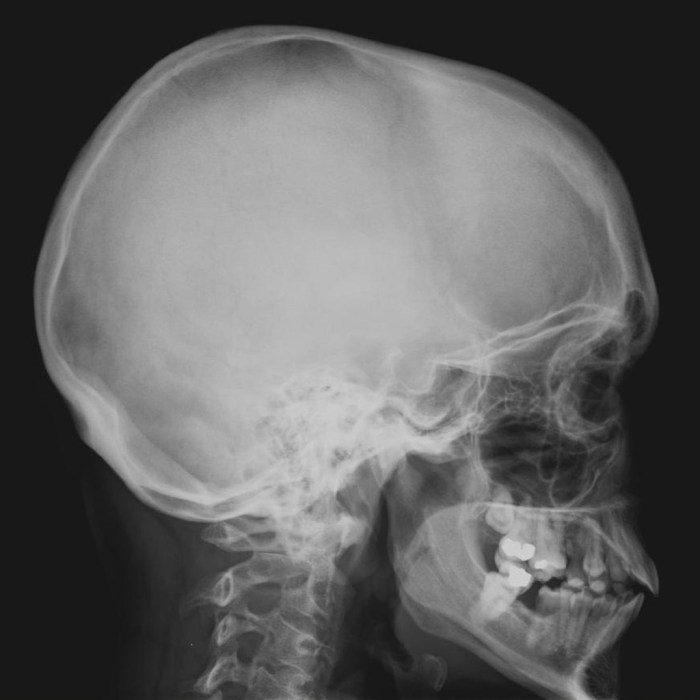 Lateral facial bones x ray