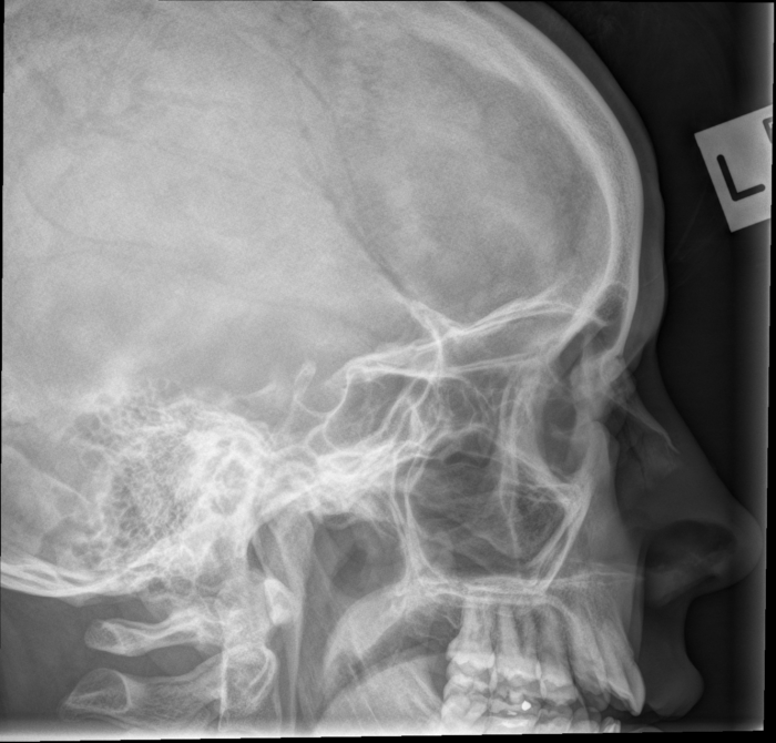 Lateral facial bones x ray