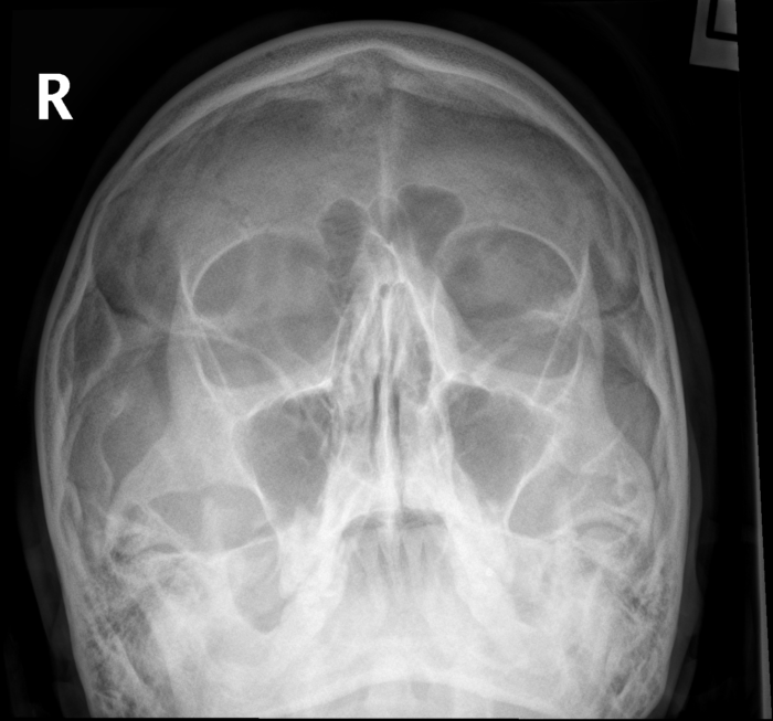 Lateral facial bones x ray