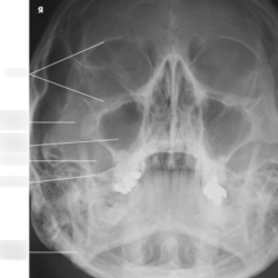 Lateral facial bones x ray