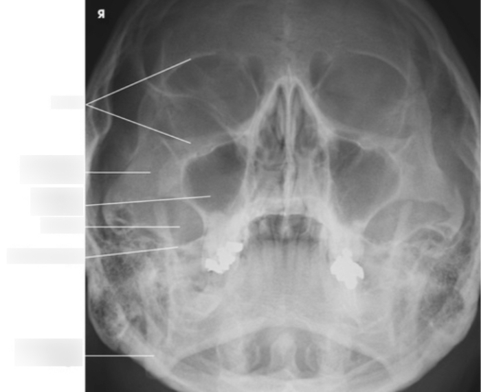 Lateral facial bones x ray